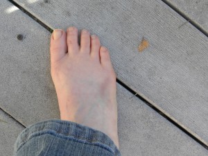 Bruised foot